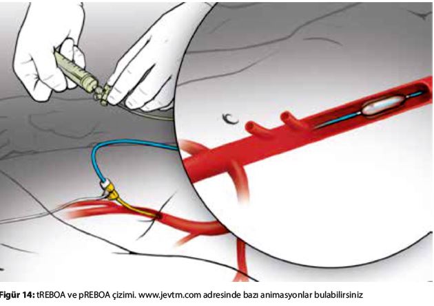 What is REBOA?